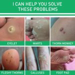 Active Corn Remover Gel-4.jpg