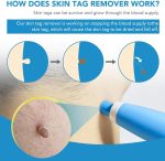 Auto Skin Tag Remover-4.jpg