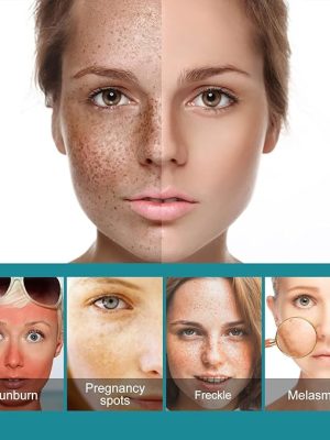 Eelhoe - Dark Spots Removes Cream (Original) - Zambeel